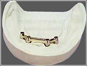 Bei zahnlosen Kiefer und Stegkonstruktionen