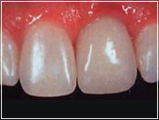 Bei Einzelzahnverlust