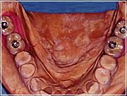 Bei nicht zahnbegrenzten Lücken