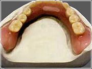 Bei zahnlosen Kiefer und Stegkonstruktionen