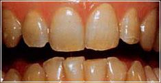 Bleaching - Vorher Bleaching - Vorher