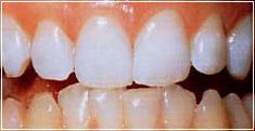 Bleaching - Nachher Bleaching - Nachher
