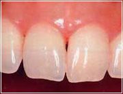 Veneer - Nachher Veneer - Nachher
